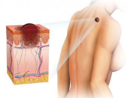 Причини и методи за отстраняване на мастната тъкан на тялото