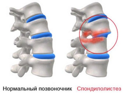 Причини и методи за лечение с дислокации на гръбначни дискове