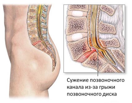 Причини, симптоми на стеноза на гръбначния канал в шията и лечение
