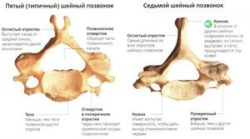 Гърло на гръбначния стълб: признаци на анатомия, типична травма на врата и профилактика на заболявания