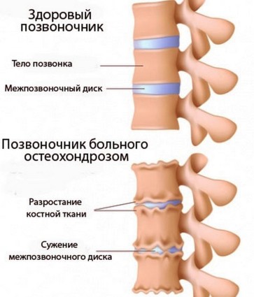 Клиниката, курса и важни симптоми при остеохондрозата на гръдния кош