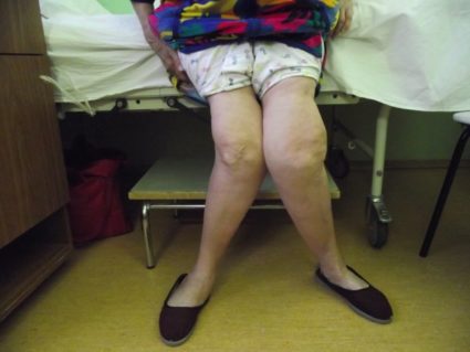 Деформиране на артрозата на колянната става - какво да правим, когато коленете изведнъж се разболеят