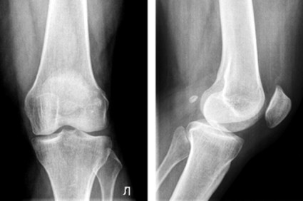 Диагностика на деформации на артрозата на коляното от 2-ра степен
