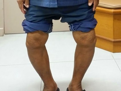 Диагностика на деформации на артрозата на коляното от 2-ра степен