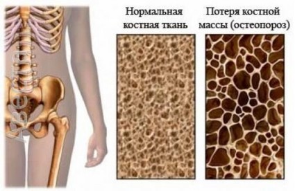 Дифузна остеопороза и нейната проява