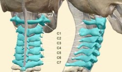 Главоболие за цервикална остеохондроза: причини и лечение