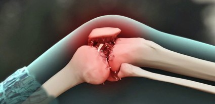 Как да разпознаете и излекувате артрита на колянната става