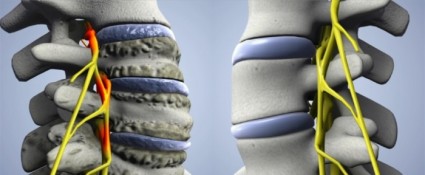 Как да разпознаем и лекуваме състоянието на не-гръбначна артроза?