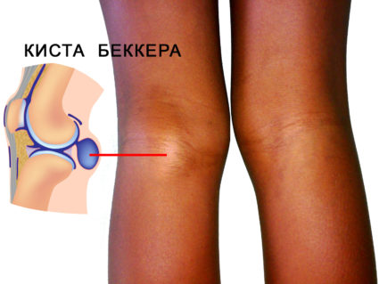 Как да се лекува киста, образувана под коляното?