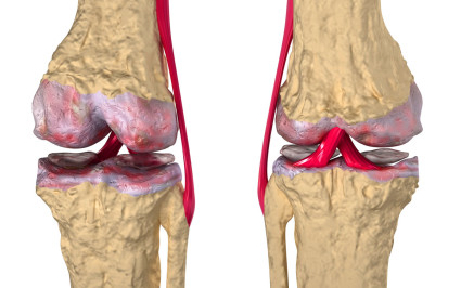 Възпалява артрозата на колянната става: лечение и отстраняване на болестта