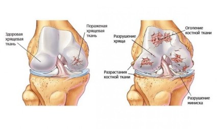 Инжекции в колянната става с артроза - лекарства и инжекции