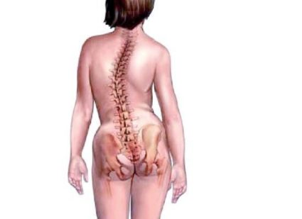 Левостранна сколиоза на гръбначния стълб - какво да правим с нея