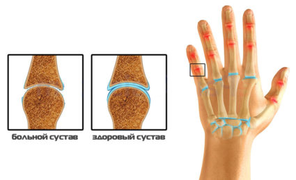 Методи за лечение и профилактика на артроза на малки стави на ръцете