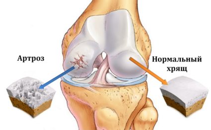 Остеоартрит от 1-ва степен на колянната става