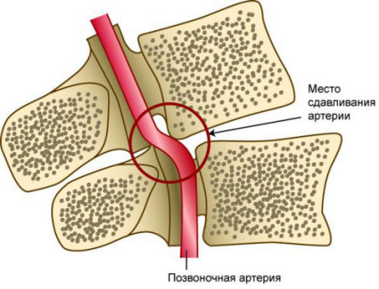 Остеохондроза и ефект върху гръбначната артерия