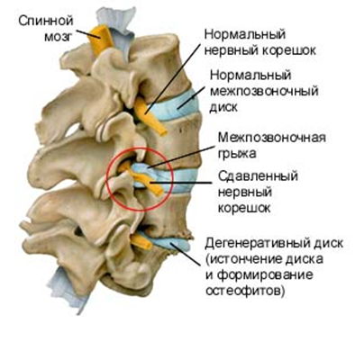 Остеохондроза на цервикалния гръбначен стълб