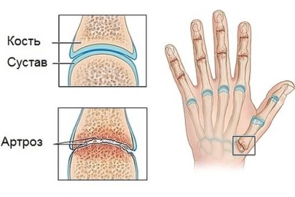 Перспективи за артроза на ръцете и ефективността на лечението