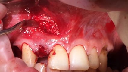 Радикална киста на долната и горната челюст, причините и лечението