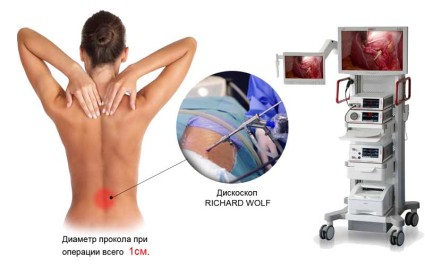Възстановяване след отстраняване на херния на диска в лумбалния гръбнак