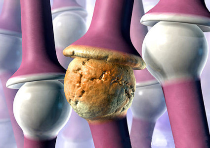 Ревматоиден артрит и неговото лечение