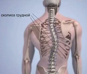 Сколиоза на гръдния кош: причини, симптоми и методи на лечение