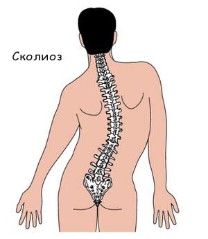 Сколиоза на гръдния кош: причини, симптоми и методи на лечение