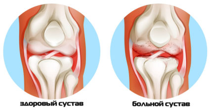 Симптоматология за различни форми на артрит на коляното и методи за лечение