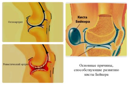 Симптоми и видове киста в колянната става