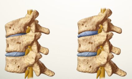 Симптоми при синдром на гръбначните артерии и методи на лечение