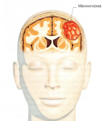 Симптомите на менингиома на мозъка, причините и лечението
