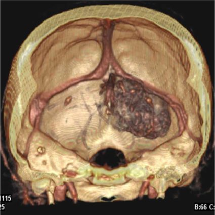 Симптомите на менингиома на мозъка, причините и лечението