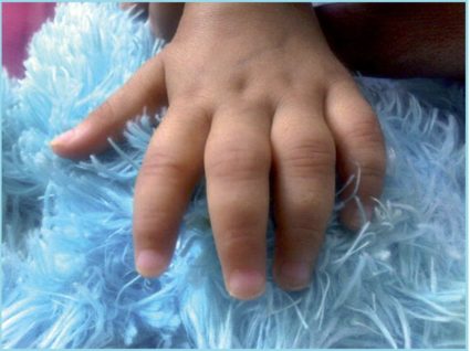 Причини за артрит при деца и формата на болестта