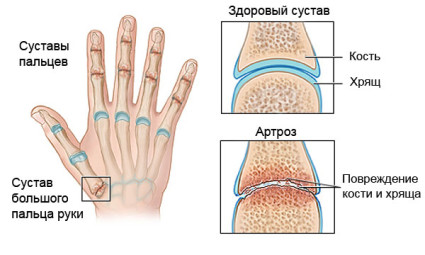 Концепцията за артроза на пръстите и борба с нея