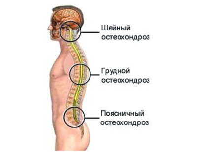 Основните симптоми на остеохондрозата на цервикалния гръбначен стълб