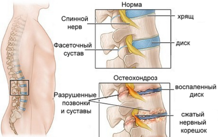 Лечение за остеохондроза на гръбначния стълб
