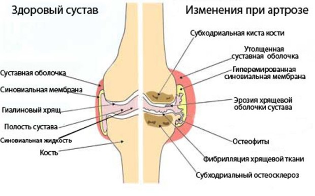 Лечение на артрозата на козметичните средства за коляното