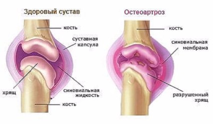 Лечение на костни остеоартрити от 1-ва степен