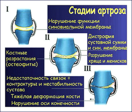 Лечение на остеоартрит на коляното от 2-ра степен
