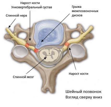 Едноклетъчна артроза на гръбначния стълб