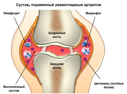Сортове и лечение на артрит на колянната става