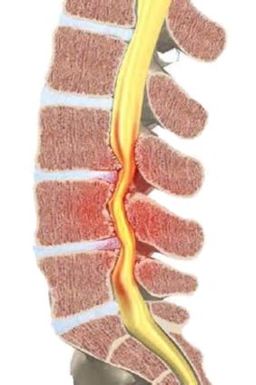 Определете спиналната стеноза в лумбалния гръбначен стълб