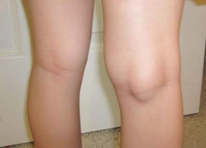 Какви са характеристиките на проявата на хигрома на колянната става