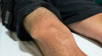 Какви са характеристиките на проявата на хигрома на колянната става