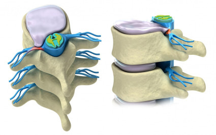 Каква е изпъкналата част на лумбалния гръбначен стълб L5-S1?