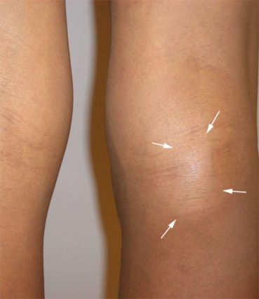 Какво води до образуването на тумор зад коляното?