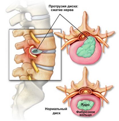 Какво трябва да знаете за изпъкналостите на дисковете в лумбалната част на гръбначния стълб?