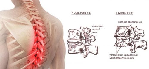 7 основни упражнения за лечение на остеохондроза в гръдния кош