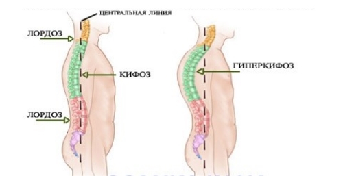 Поява на хиперкипофиза на гръбначния стълб