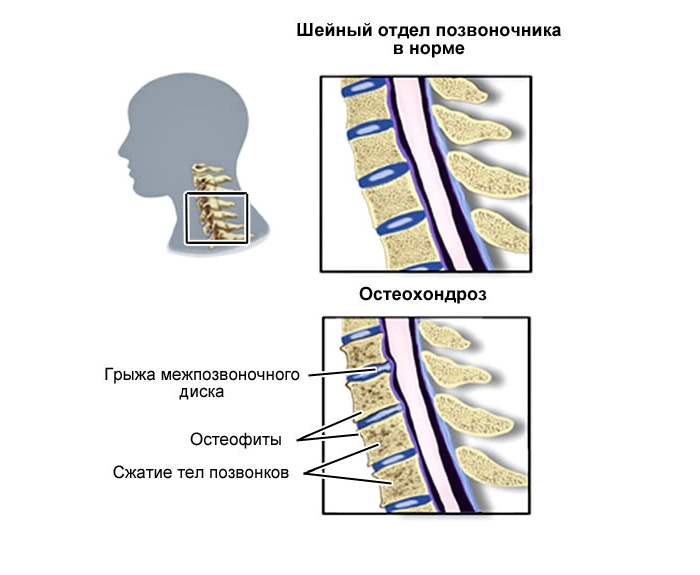 Основа на гимнастиката Бутимова с остеохондроза на цервикалния отдел