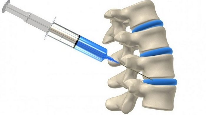 Блокада на гръбначния стълб: при какви условия се показва, прегледи и разходи